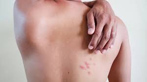 Image result for shingles in children
