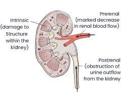 Initially there are generally no symptoms; Kidney Failure Treatment In Ludhiana Chronic Renal Failure Treatment In Punjab