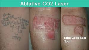 Laser Tattoo Removal The Savior