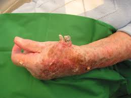 Image result for cornu cutaneum)