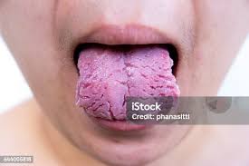 Image result for Fissured tongue