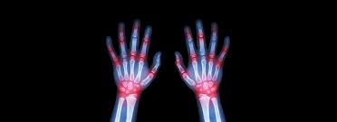Ulnocarpal Abutment | Radsource