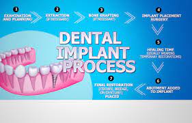 Want To Learn More About The Steps To Your New Smile Visit Http Www Kingsdentaltx Com Newsmile Dental Implants Implants Dental Implants Cost