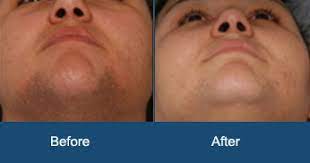 Webmd explains laser hair removal, including costs, benefits, and side effects. Permanent Laser Hair Removal Delhi Laser Hair Removal Cost In India Cosmetic Dermatology India