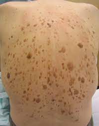 We did not find results for: Seborrheic Keratosis Wikipedia