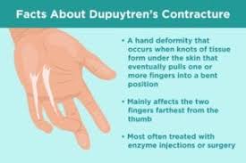 When i do so, the top of. Dupuytren S Contracture Common Questions And Answers