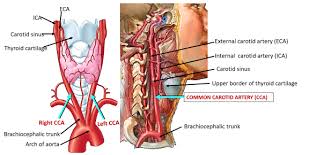 We did not find results for: Common Carotid Artery Carotid Sinus Carotid Body Anatomyqa