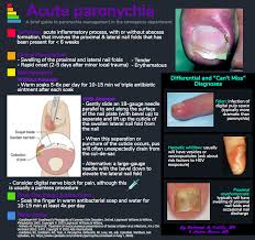 Image result for paronychium