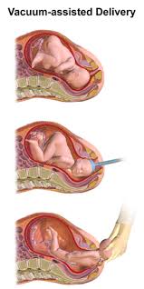 Image result for Vacuum Caput