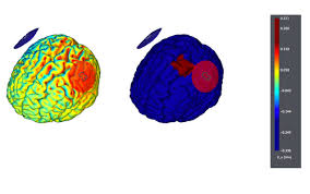 Montages For Tcs Neuroelectrics Wiki