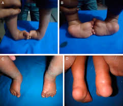 It is intended to be used in support of training… Management Of Idiopathic Clubfoot By Ponseti Technique In Children Presenting After One Year Of Age The Journal Of Foot And Ankle Surgery