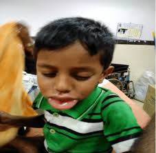 Bee Sting Angioedema of Lip