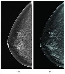 A dense breast has relatively less fat and more glandular and connective tissue. Tmist Trial Comparing Breast Cancer Screening Approaches National Cancer Institute