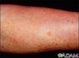Image result for liver spots on legs