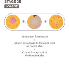 Staging is the process of finding out how much cancer there is and where it is located. Stages Archives National Breast Cancer Foundation