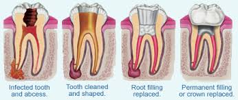 Cost will depend on the location of the tooth, surrounding nerves, and the difficulty of removal. Cheap Best Root Canal Treatment In Dubai Uae