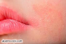 Dermatita atopică este o boală a pielii unei etiologii alergice. Dermatita Atopica Bebelusi Forum Danihilldesign Com