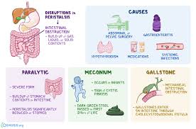 Ileus What Is It Types Causes Diagnosis Treatment And More Osmosis