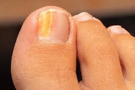 Image result for Yellow nail syndrome feet
