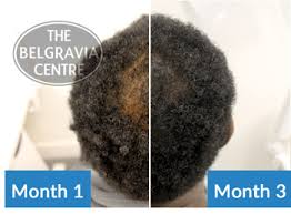Ok guys, a lot of us bearded dudes have thinning hair, and we need to have an ultimate guide on how to handle it. Can You Treat A Thinning Crown In Men With Afro Hair