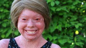 The skin abnormalities associated with harlequin ichthyosis. Harlequin Ichthyosis Explore Tumblr Posts And Blogs Tumgir