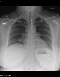 Iphone 6 Charger Ingested Foreign Body Radiology Case Radiopaedia Org Radiology Body Iphone 6