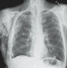 Rt Side Pleural Effusion Surgical Emphysema With Chest Drain Placed On The Rt Upper Third Rib Below The Clavicle Radiology Pleural Effusion Respiratory System