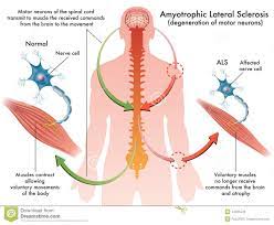 Estas neuronas transmiten mensajes desde el cerebro y la médula espinal hacia los músculos voluntarios, los que usted puede. Als Esclerosis Lateral Amiotrofica Ilustracion Del Vector Ilustracion De Swallowing Gehrig 44835540