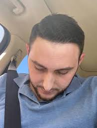 Tijuana Hair Transplant Reviews and Testimonials