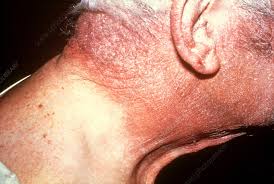 Image result for Photodermatitis