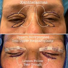 Image result for xanthelasma of eyelid