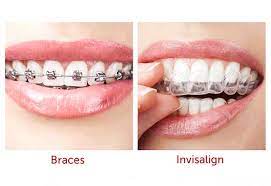 The aligner is made from a flexible thermoplastic material named smarttrack. Invisalign Vs Braces Cost Which Is The Better Investment Dental Health Society