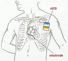 Brugada Syndrome Wikipedia
