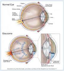 Build Up Of Aqueous Humor Medical Illustration Eye Facts Eye Health