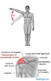 Supraspinatus Tendon Tendinitis Tendinosis And Tear Supraspinatus Tendonitis Supraspinatus Tendon Tear Tendinitis
