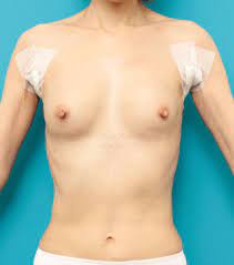 肋骨(あばら骨)が浮き出ているくらいガリガリに痩せている女性にシリコンプロテーゼ豊胸手術を行い、 : 高須クリニック高須幹弥の美容整形症例画像写真集