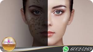 Criolipolisis Santa Cruz Bolivia