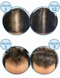 If you are dealing with female hair loss, we suggest trying natural cures such as biotin. Could Targeting Cxxc5 Protein Cure Baldness And Regrow Hair
