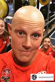 Alopecia areata is classified as an autoimmune disorder. Rugby S Heather Fisher On Coping With Alopecia Areata Baldness