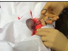 Once a boil has drained, keep it draining of puss with warm water compresses. Medflixs Abscesses Abscess Removal Drainage And More By Drer