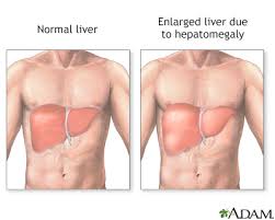 Pain or fullness can be felt on the left upper part of the abdomen. Hepatomegaly Information Mount Sinai New York