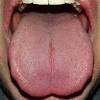 If you smoke, drink excessive amounts of alcohol or have a poor diet, changing these habits can decrease the chances of developing oral cancer. 1