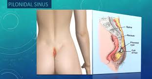 When it's infected, a pilonidal cyst becomes a swollen mass (abscess). Pilonidal Sinus Dr Shashikant S Jadhav