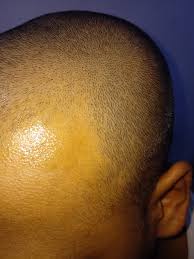 Q sera hair serum work slowly in reducing the hair fall and also gives only a temporary solution to your hair loss problems. Which Is Better A Mintop 5 Or A Mintop Pro For Hair Regrowth Quora