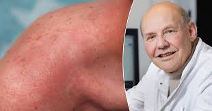 Als je deze medicatie inneemt, mag je nooit in de zon komen: “Je kan er  blaren, roodheid en een verhoogd risico op huidkanker aan overhouden”