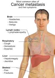 Learn about cancer symptoms & other warning signs of cancer from the experts at cleveland clinic. What Is The Signs Of Liver Cancer