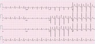 We did not find results for: Sinus Tachycardia Wikipedia