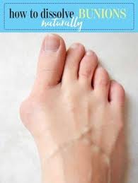 Homeremediesforbunions Bunions Hurt To Lessen The Discomfort You Feel You Should Learn How To Soothe The Irritatio Bunion Treatment Bunion Bunion Remedies