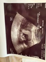 Image result for Friable Cervix