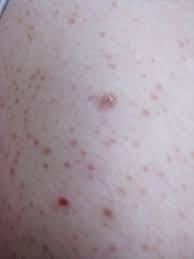 Image result for scabies human bites